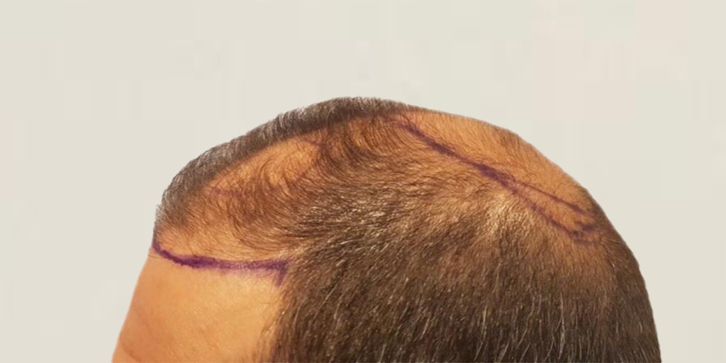 Método FUE y medicina capilar en CM-Clinic - Resultado antes Método FUE y medicina capilar en CM-Clinic - Resultado antes